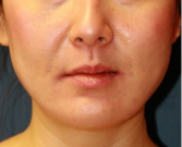 Feel Beautiful - Liposuction Lower Face 210 - After Photo